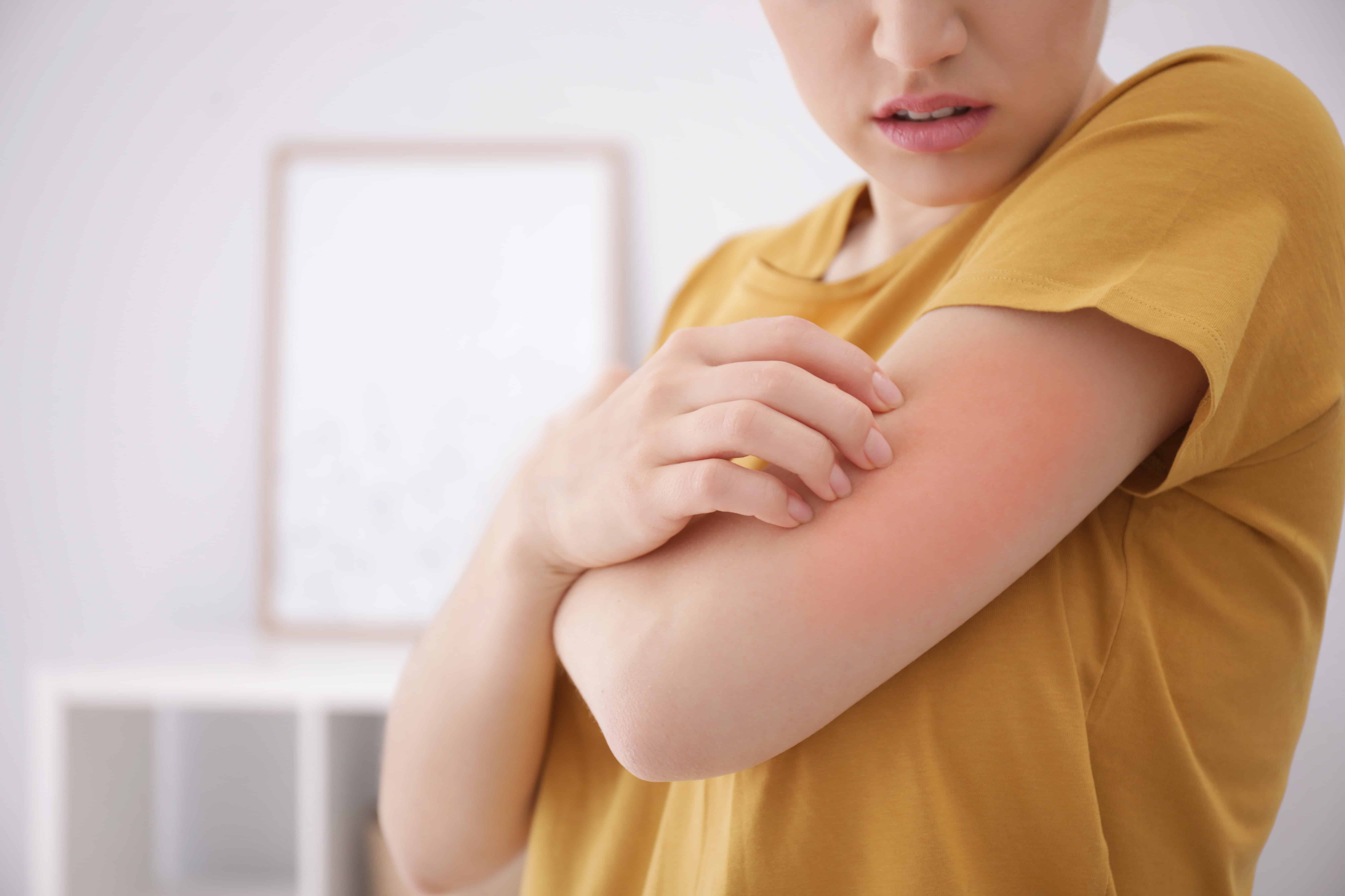 Close up of a woman having an allergic reaction